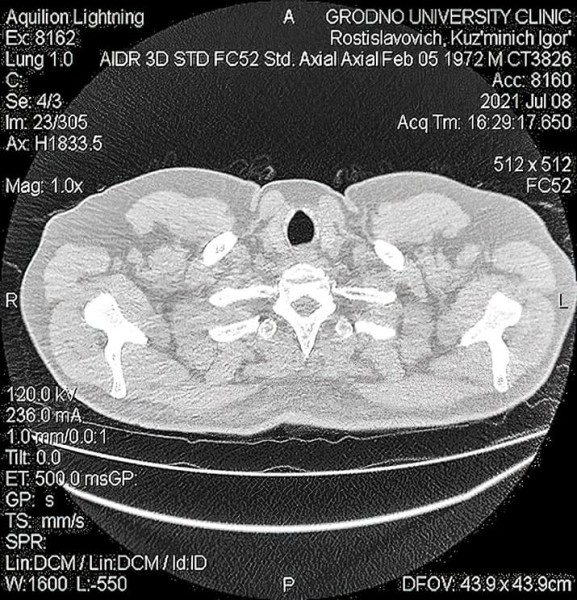 
        COVID-ассоциированный инвазивный легочный аспергиллез: проблемы диагностики и лечения			    