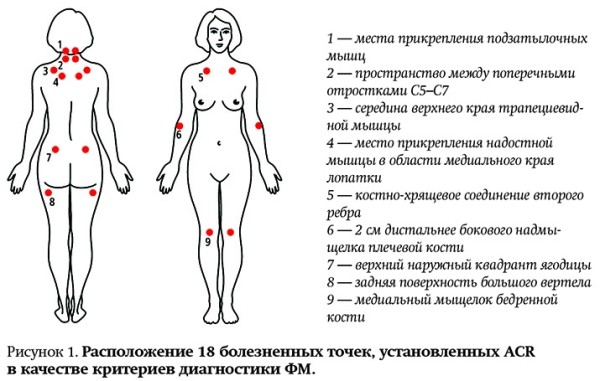 
        Современные аспекты диагностики и лечения фибромиалгии			    