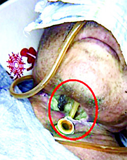 Онкологические заболевания гортани. Еще раз о важности регулярного наблюдения у профильных специалистов
Онкологические заболевания гортани. Еще раз о важности регулярного наблюдения у профильных специалистов