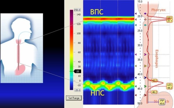 Манометрия пищевода высокого разрешения
Манометрия пищевода высокого разрешения