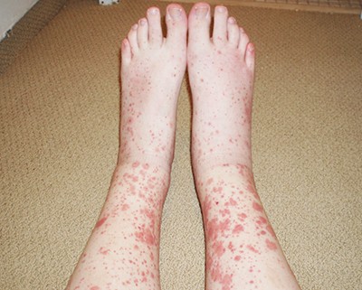 
        Дерматологические осложнения COVID-19 и тактика ведения пациентов с заболеваниями кожи			    