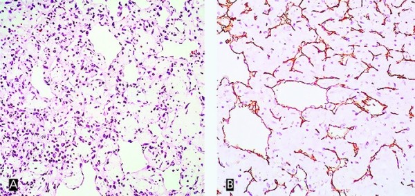 
        Опухоль в сердце: сложности диагностики и хирургии			    