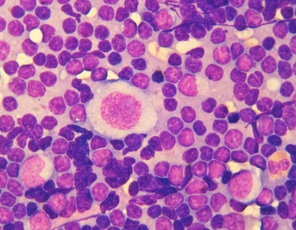 
        Лимфома Ходжкина у детей и подростков			    