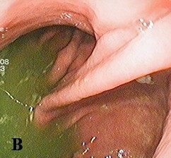 Халитоз: от симптома к диагнозу и терапии
Халитоз: от симптома к диагнозу и терапии
