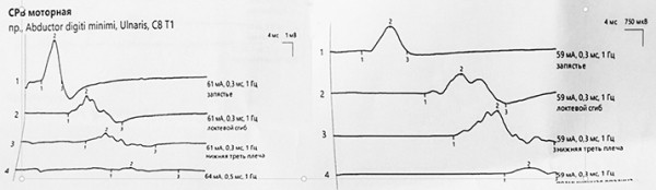 
        SARS-CoV-2 как триггер дебюта и прогрессирования неврологических заболеваний. Часть 2			
        
        