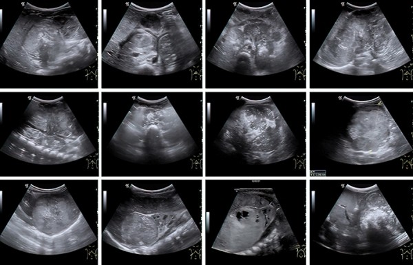 
        Нейробластома у детей: пути снижения запущенных случаев			    