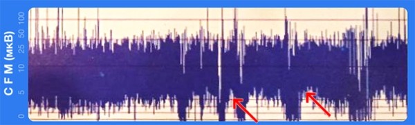 Терапевтическая гипотермия в неонатологии
Терапевтическая гипотермия в неонатологии