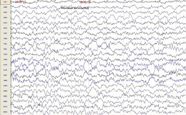 
        Пароксизмальные состояния у детей неэпилептического характера			    