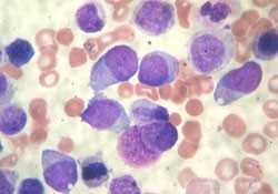 Острый миелоидный лейкоз у детей
Острый миелоидный лейкоз у детей