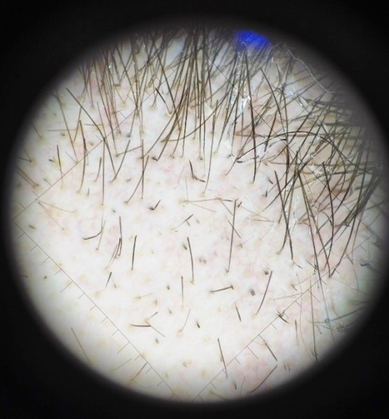 
        COVID-19 и выпадение волос			    