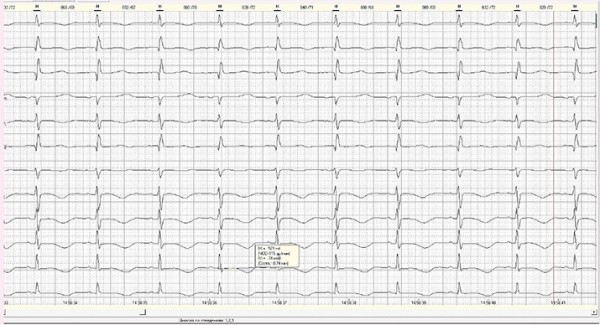 
        Диагностика врожденного синдрома  удлиненного интервала QT			    
