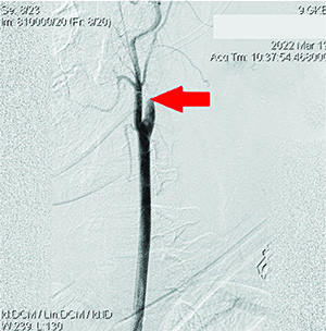 
        Острый ишемический инсульт у подростка: опыт комбинированного внутрисосудистого тромболизиса			    