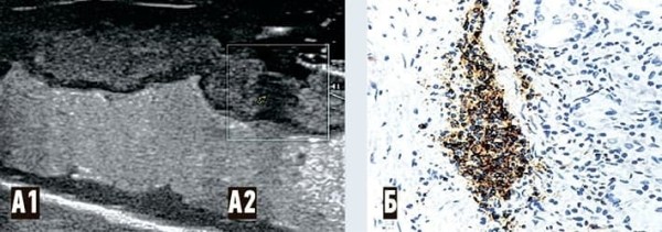 
        COVID-19-ассоциированные  изменения ЖКТ: данные ультразвуковых  и морфологических исследований			    
