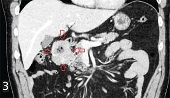 
        Гастроинтестинальные стромальные опухоли: взгляд рентгенолога			    