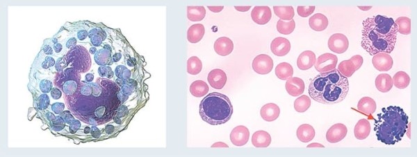 
        Лейкоцитоз. Как правильно сдать анализ крови и расшифровать результат? 			    