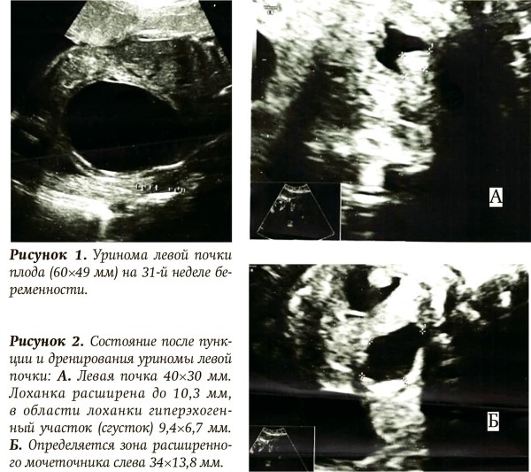 Обструкция верхних отделов мочевыводящей системы у плода. Клинический случай
Обструкция верхних отделов мочевыводящей системы у плода. Клинический случай