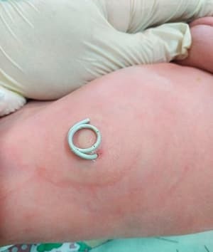 Обструкция верхних отделов мочевыводящей системы у плода. Клинический случай
Обструкция верхних отделов мочевыводящей системы у плода. Клинический случай