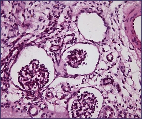 
        Морфологическая диагностика в детской нефрологии			    