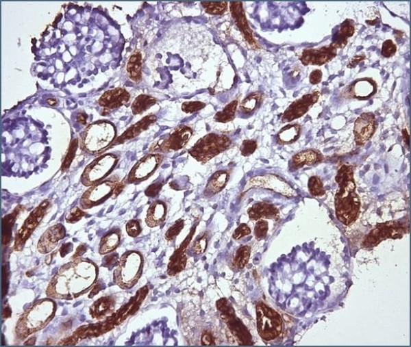 
        Морфологическая диагностика в детской нефрологии			    