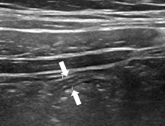
        Алгоритм ультразвуковой диагностики острого аппендицита			    
