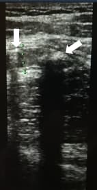 Алгоритм ультразвуковой диагностики острого аппендицита
Алгоритм ультразвуковой диагностики острого аппендицита