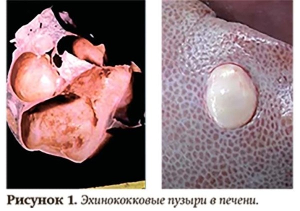 
        Эхинококкоз: как избежать послеоперационных рецидивов			    
