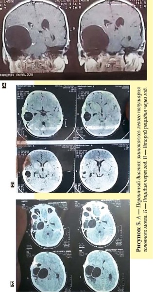 
        Эхинококкоз: как избежать послеоперационных рецидивов			    