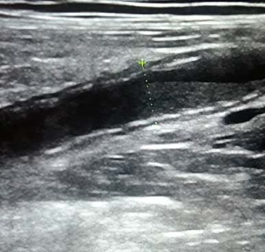 
        Алгоритм ультразвуковой диагностики острого аппендицита			    