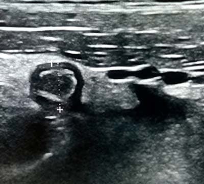 
        Алгоритм ультразвуковой диагностики острого аппендицита			    