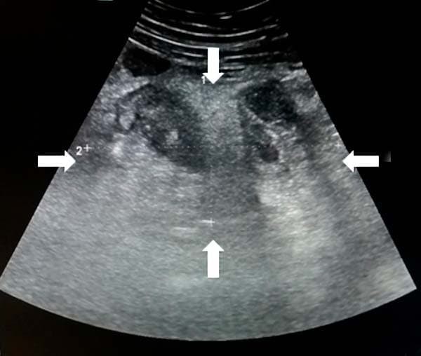 
        Алгоритм ультразвуковой диагностики острого аппендицита			    