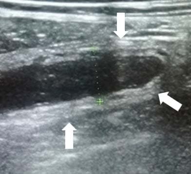 
        Алгоритм ультразвуковой диагностики острого аппендицита			    