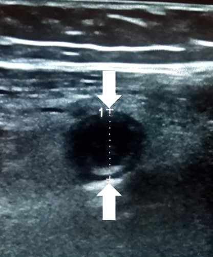 
        Алгоритм ультразвуковой диагностики острого аппендицита			    