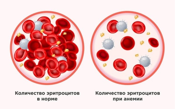 
        Дефицит железа не редкость среди молодых женщин			    