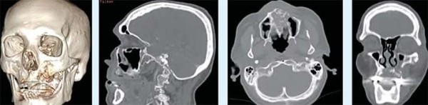 
        Постковидные остеонекрозы костей лицевого отдела черепа			    