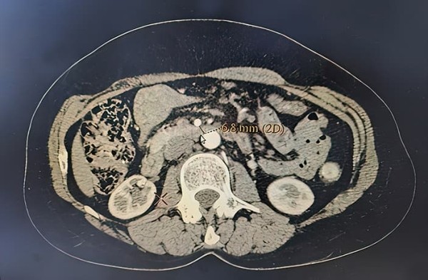 
        Лапароскопический дуоденоэнтероанастомоз при синдроме верхней брыжеечной артерии			    