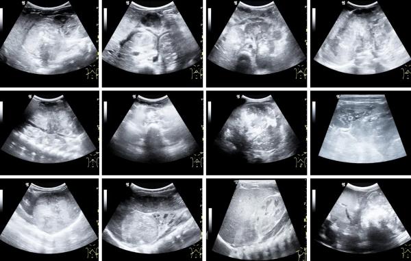 
        Ультразвуковая диагностика абдоминальных эмбриональных опухолей			    