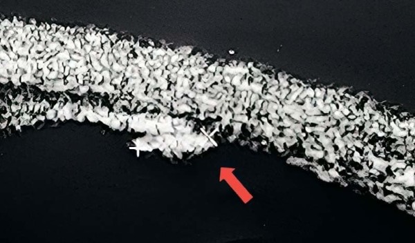 
        Внутриглазная миграция металлического инородного тела			    